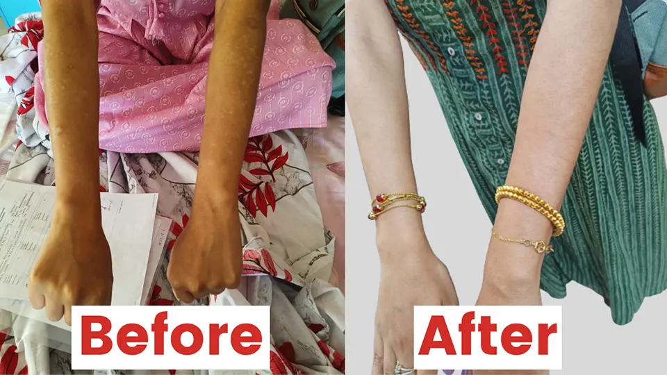 Oindrila Bhar Balance Within Cure Psoriasis - before and after hands