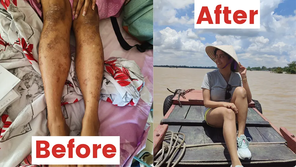 Oindrila Bhar Balance Within Cure Psoriasis - before and after legs